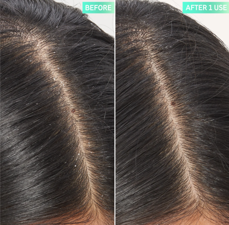 The INKEY List, Salicylic Acid Exfoliating Scalp Treatment