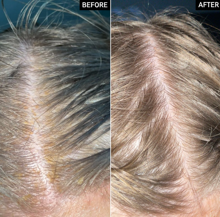 The INKEY List, Salicylic Acid Exfoliating Scalp Treatment