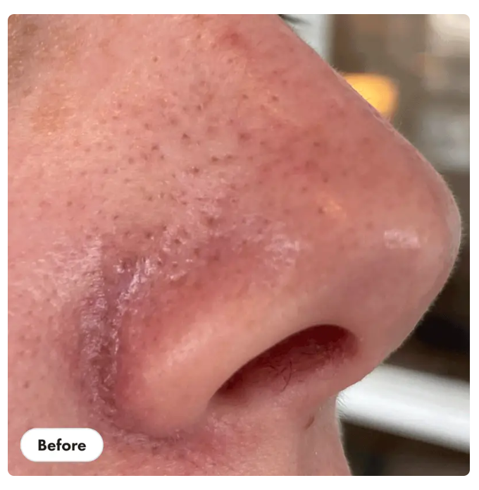 Hero Cosmetics, Pore Release The blackhead solution