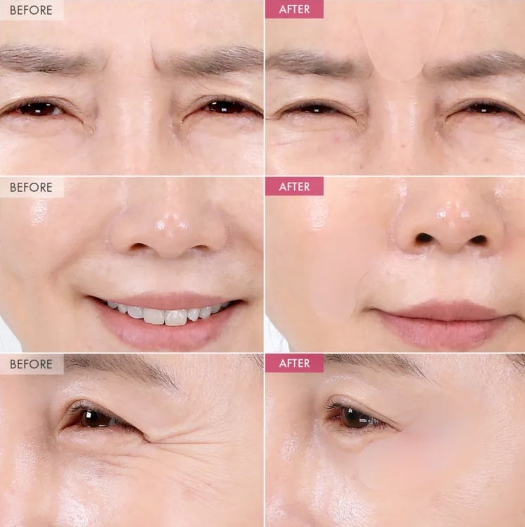 TOSOWOONG - SOS Intensive Magic Clinic Anti-Wrinkle Patch 10 patches * 5 