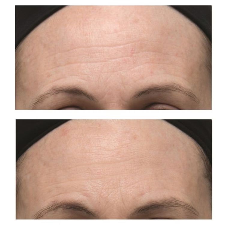 Dr. Dennis Gross Skincare Alpha Beta Ultra Gentle Daily Peel 3 Treatments