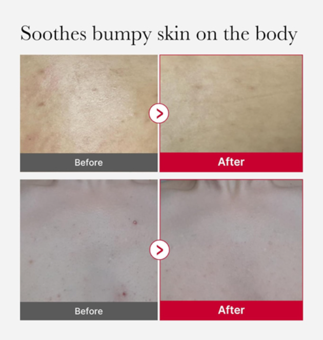 Medicube, Red Acne Body Peeling Shot 