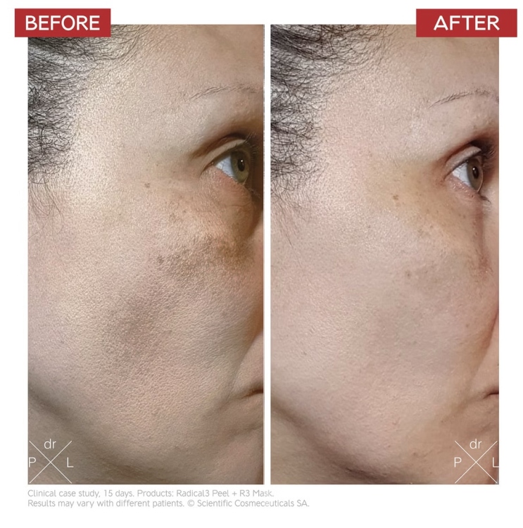 Dr. LEVY Switzerland Redical 3 Reboot Pro Peel 50ml