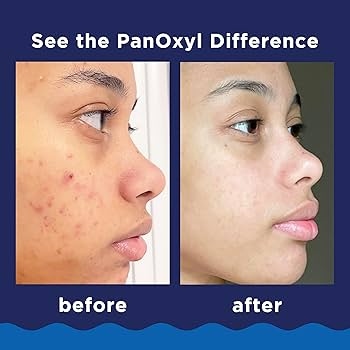 PanOxyl Acne Foaming Wash Benzoyl Peroxide 10% /156 g